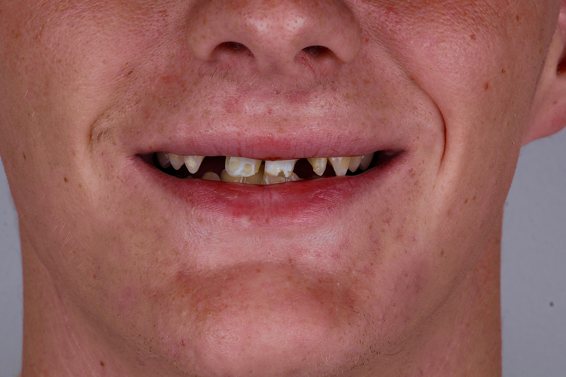 Antes